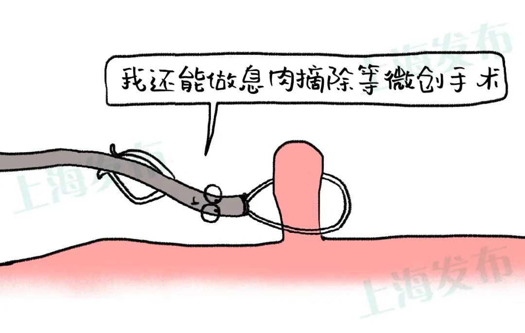 肠息肉是怎么长出来的?要不要割?