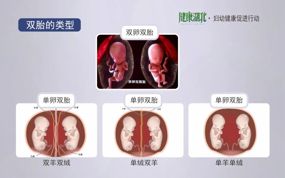 双胎输血综合征,通俗来说,是一个胎儿成为供血儿,另一个胎儿成为受