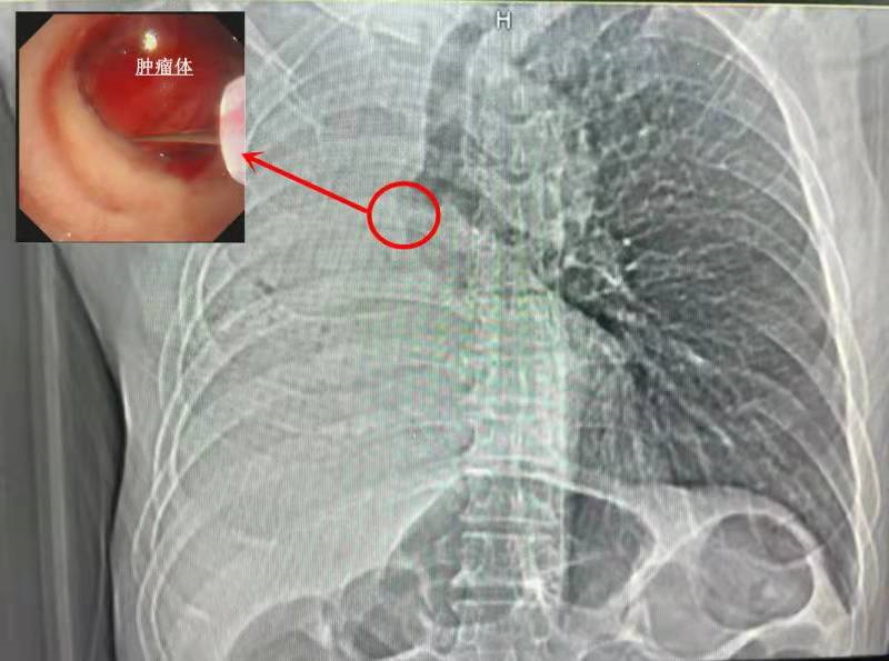 手指粗肉瘤突然疯长进男子支气管三四十年烟龄酒龄成为肿瘤温床