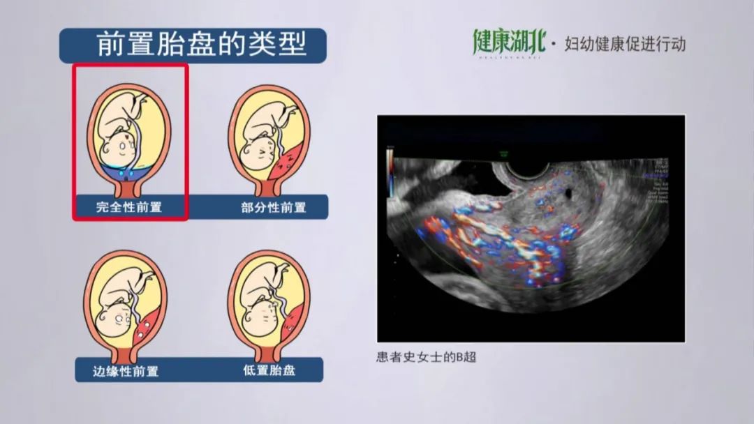 根据胎盘下缘与宫颈口内的关系,将前置胎盘分为以下四种类型:完全性
