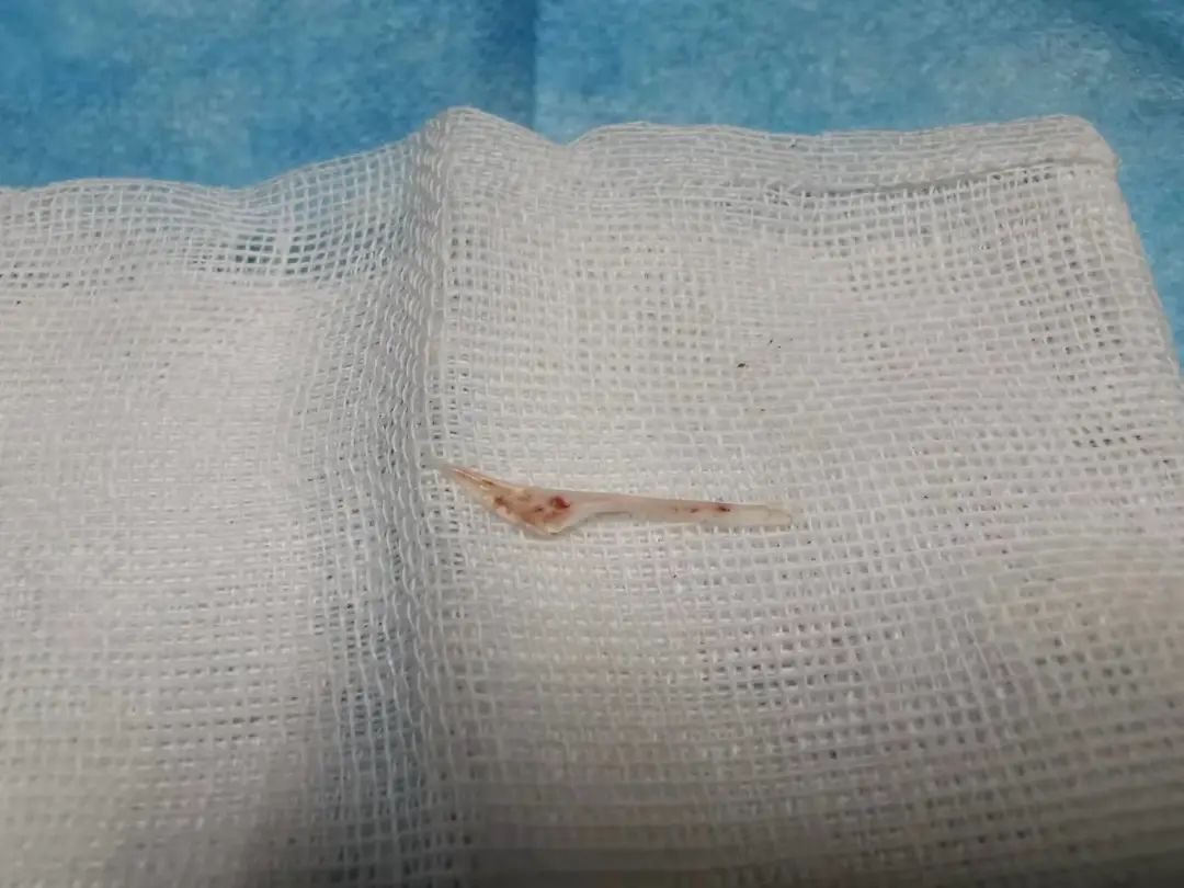 一根鱼刺的杀伤力有多大