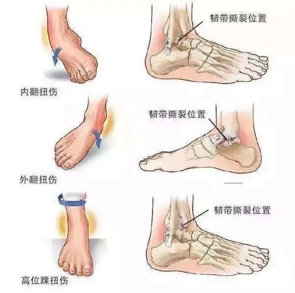 冬奥会来了如何处理运动损伤协和医生奉上最全防护指南