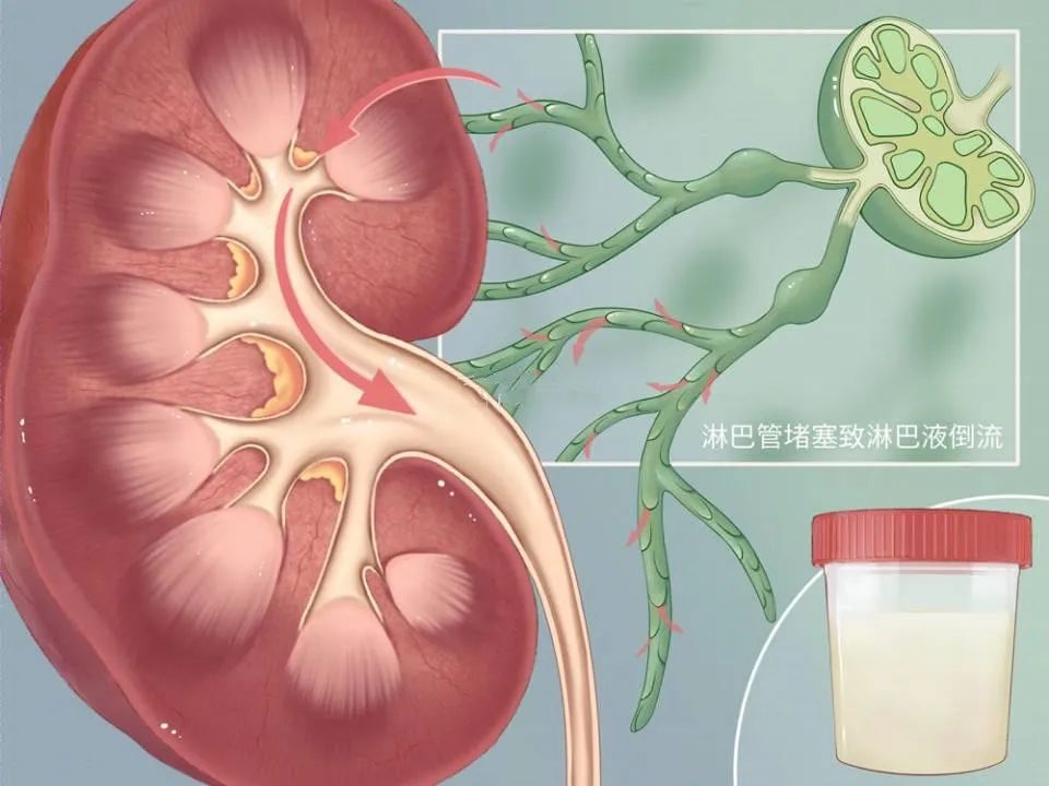 27岁象山小伙每天产奶2斤竟是这里漏了