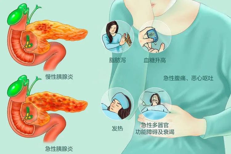 近年来,随着人们生活水平越来越好,高血脂人群增多,高脂血症性胰腺炎