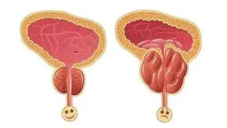 前列腺增生的症狀no.