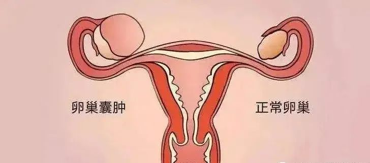 卵巢囊肿b超图片