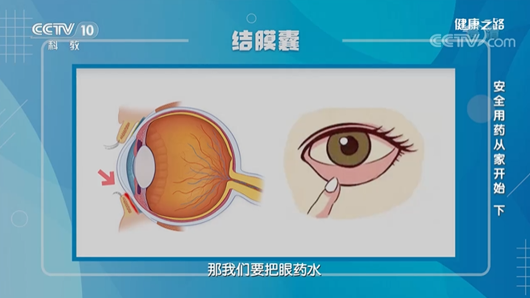 眼药膏涂结膜囊内图片图片