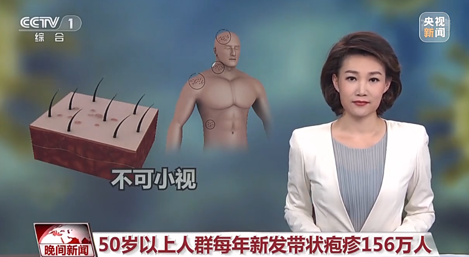 蛇盘疮有多恐怖体内有这种病毒的人要小心