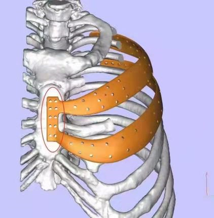 肿瘤侵袭男子胸骨3d打印助其重塑新胸廓