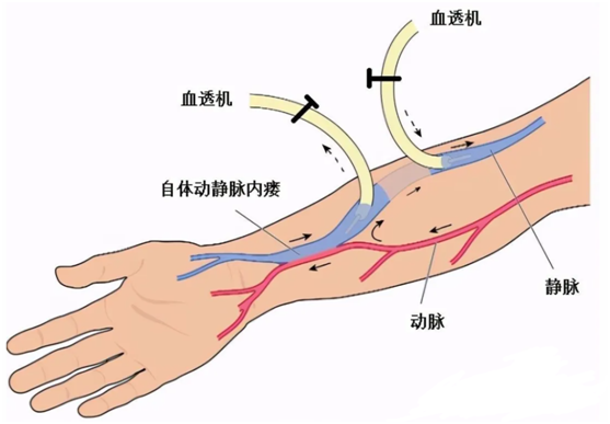 維護血液透析患者的生命線這些知識點要牢記