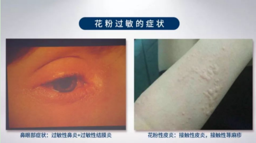 谨防花粉过敏疫情下赏花口罩到底怎么选