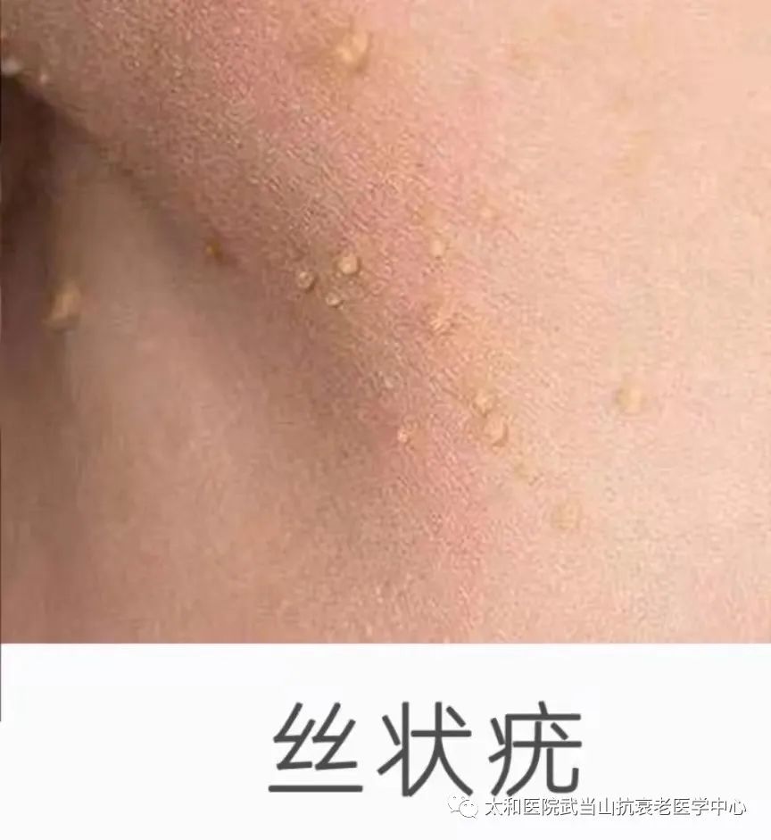 hpv病毒可能导致皮肤癌,黏膜型的高危型hpv病毒可能导致宫颈癌,外阴癌