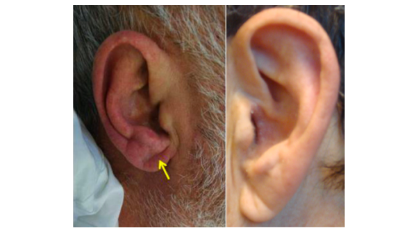 其实,关于耳垂折痕与冠心病的关系,早在1973年,美国的科学家sonders t