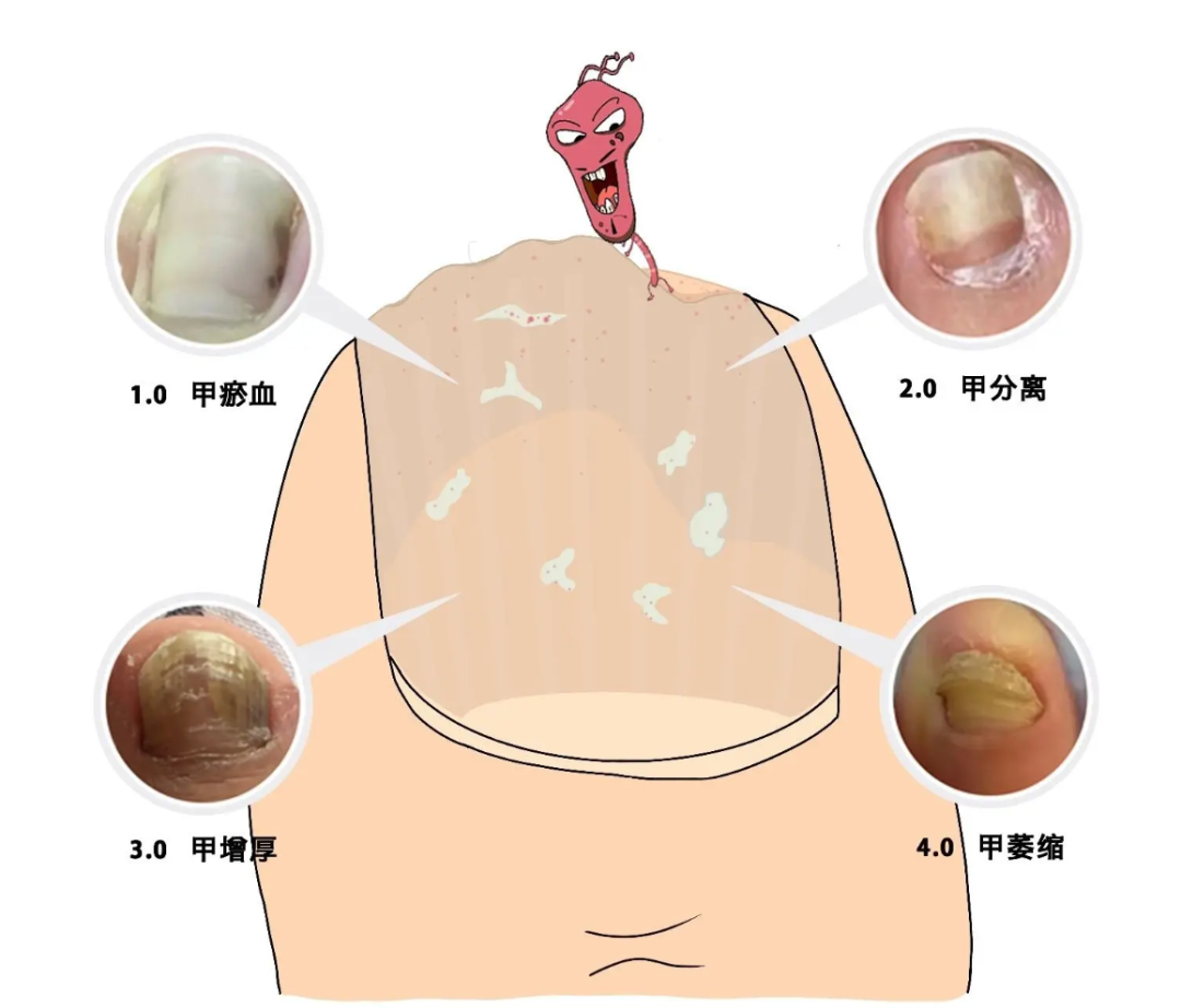 得了灰指甲要拔甲医生假的