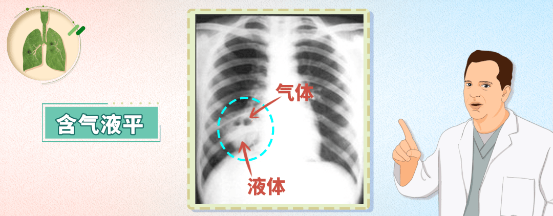 肺部气液平面图片