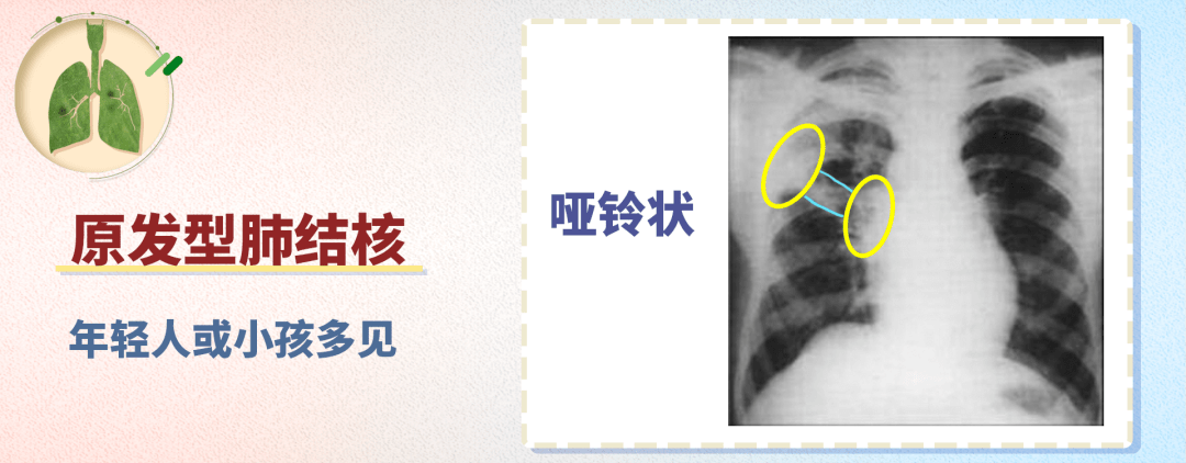 當然,肺結核的感染常常不限於局部,除了一個較大的主病灶以外,周邊還