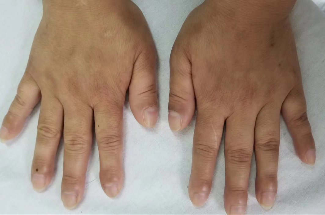 手指上恶性肿瘤的表现图片