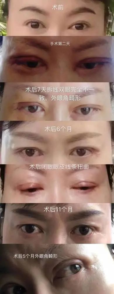 其中,何芳称,她因对眼部不满意,于2009年9月接受了双眼皮手术.