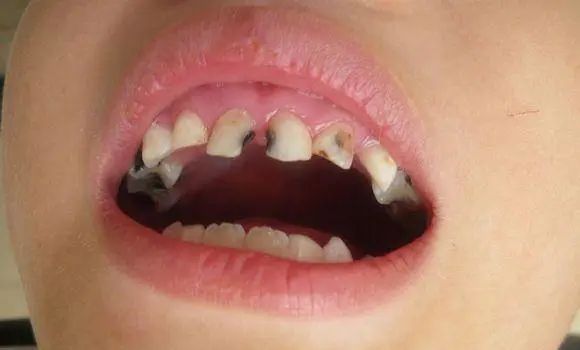 什麼是乳牙齲病?dental caries in children二.