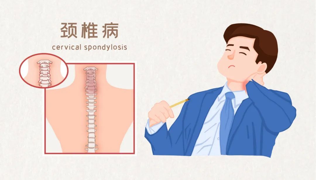 颈椎问题牵一发而动全身快来看看颈椎病离你有多远