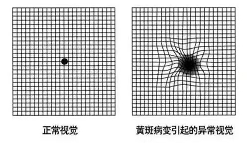 老年人看歪直線莫忽視警惕黃斑變性這種致盲眼病