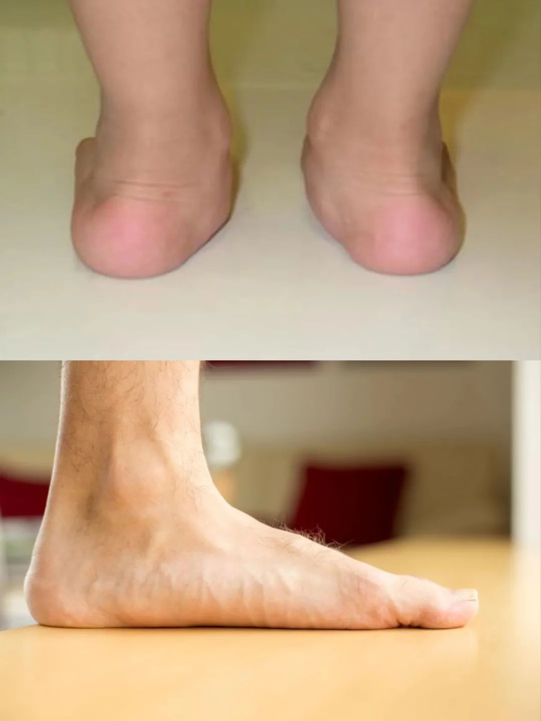 帮您的孩子看看双脚,是否有"足后跟外翻",前面看是否有"足内侧突起"