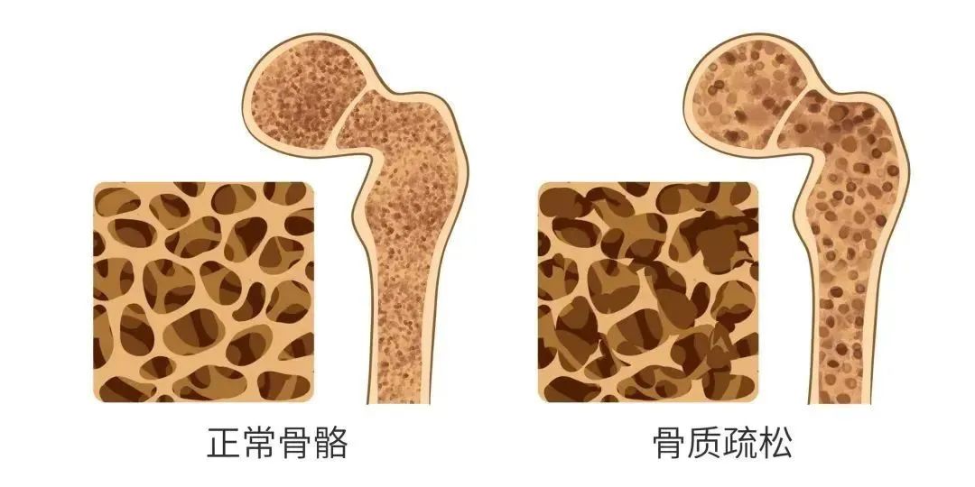 手撐了下地就手腕骨折了,甚至撞一下就肋骨骨折了,這就是骨質疏鬆惹的