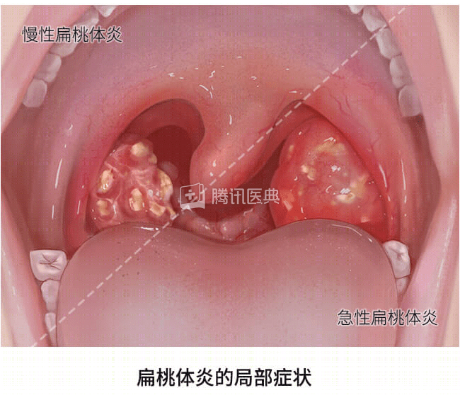 口臭难忍可能是嘴里藏了垃圾桶