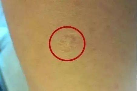 打了疫苗没有留下疤痕是没起作用吗