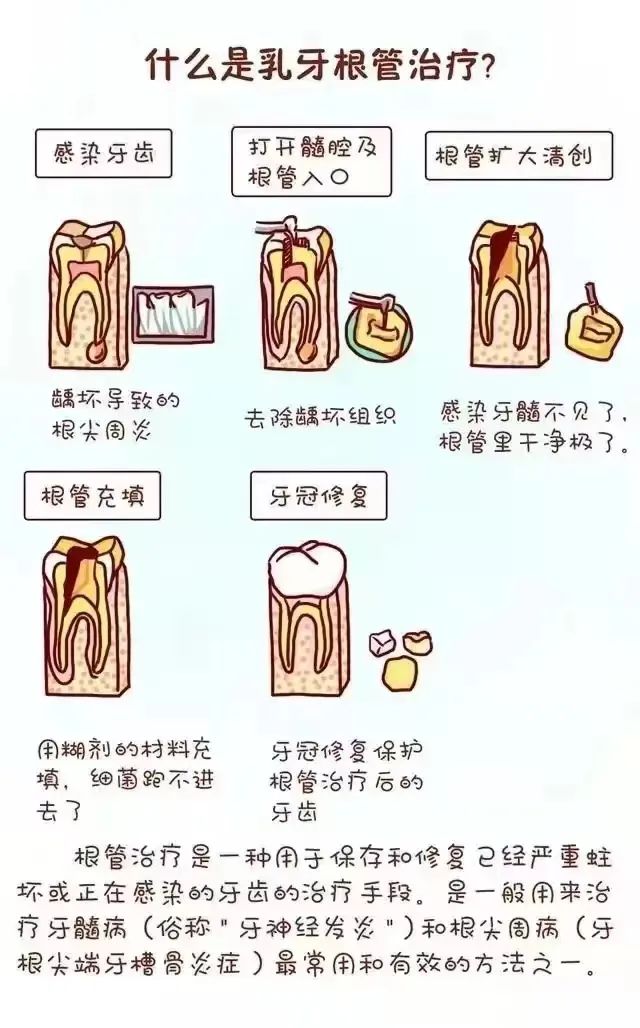 乳牙根管解剖图图片
