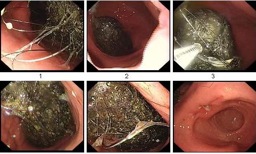 13岁女孩腹痛就诊医生竟从胃部取出大量头发只因她长期有这个习惯