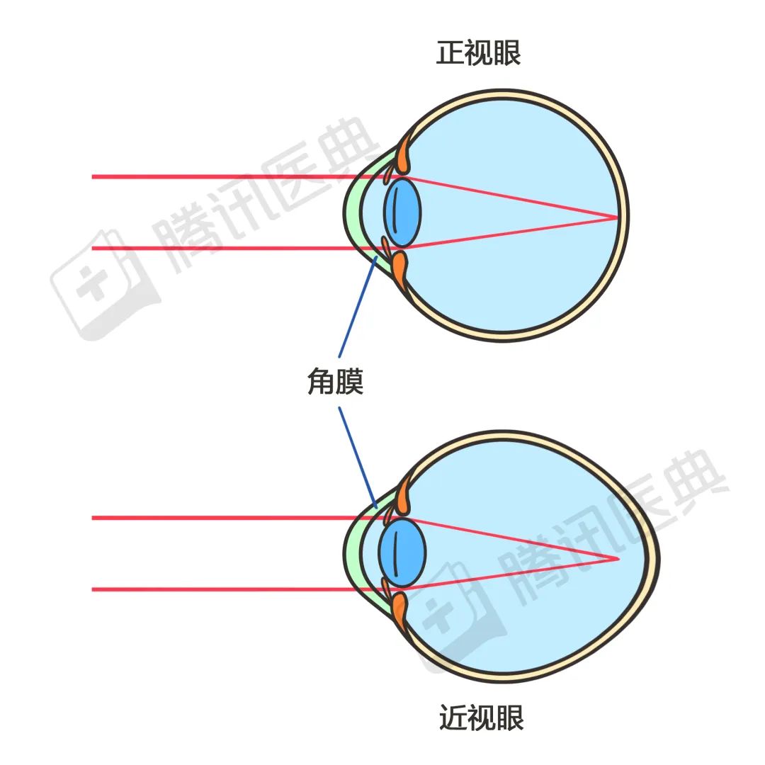 近视的你老了可能需要2副眼镜