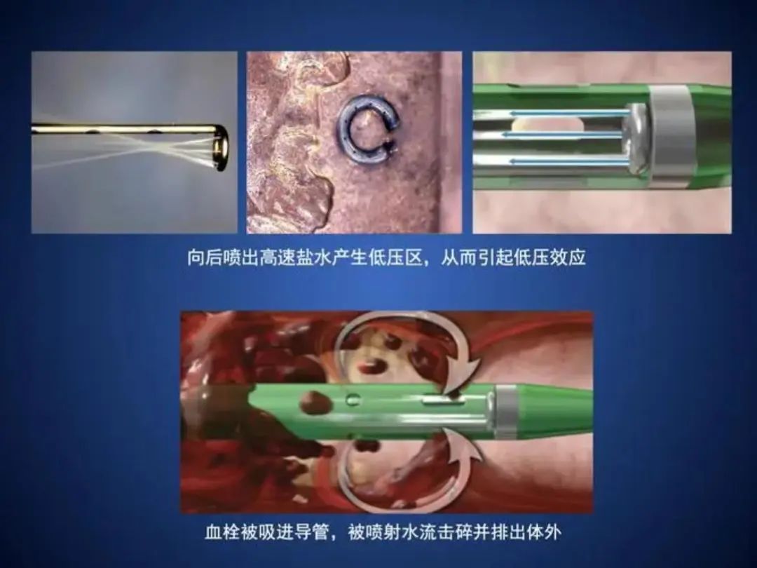 久坐不动腿变粗下肢深静脉血栓治疗要趁早