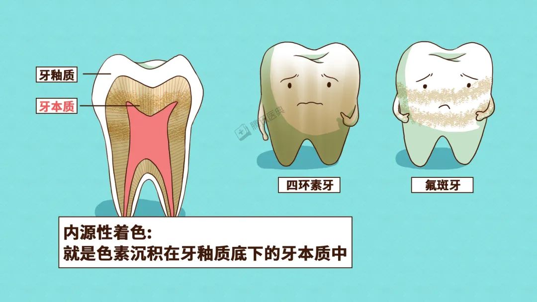 通俗来讲,就是牙齿在发育时接受到了过量的氟,造成了牙釉质发育不全