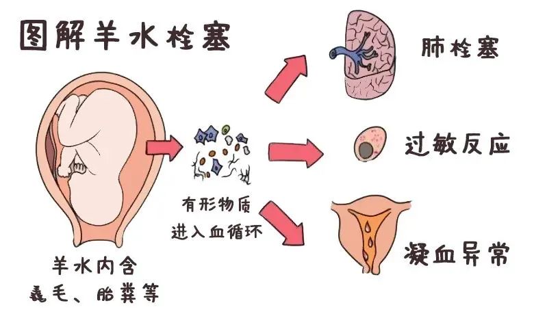 羊水栓塞漫画图片