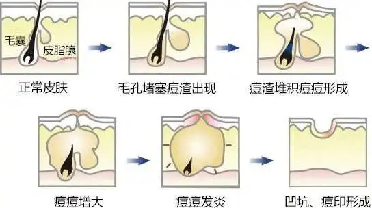 痤疮检查报告图片图片