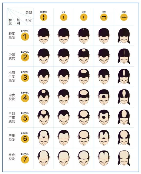 67脱发青年自救有多拼仨月不洗头只因秃伤悲