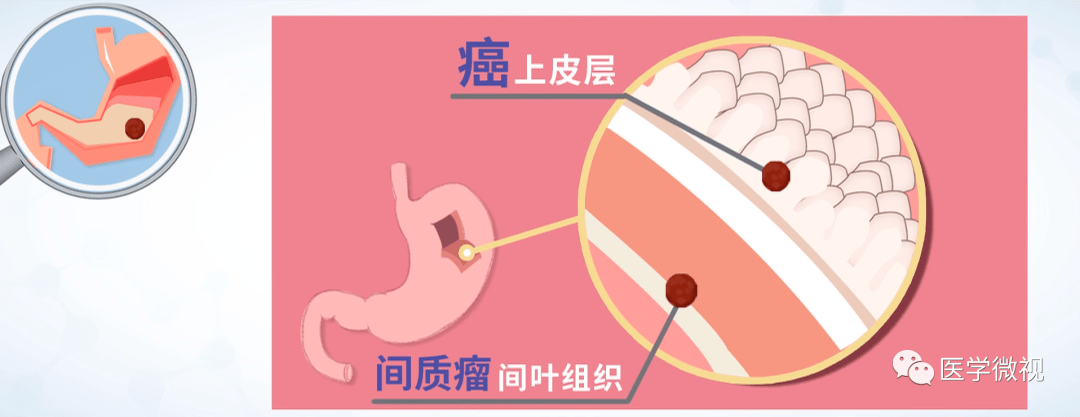 层(上皮层);而胃肠道间质瘤,则最初生长于表层以下的中间层(间叶组织)