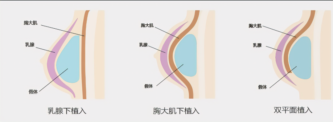 要豐胸是按摩吃木瓜還是唯有手術醫生這麼說