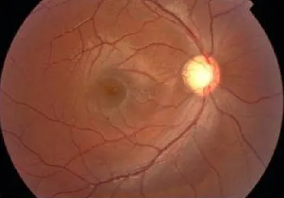 青光眼是一组具有特征性视神经损害和视野缺损的眼病