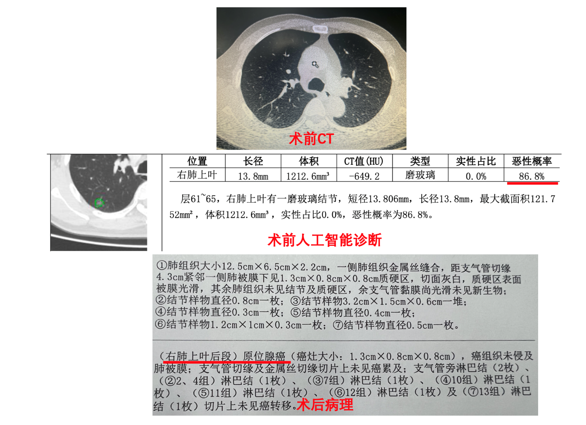 肺结节诊断报告图片图片