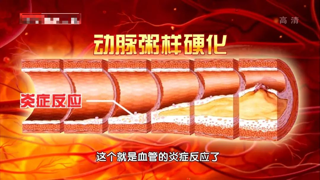 专家们提醒,好多心血管疾病起初的原因都是血管的炎症.