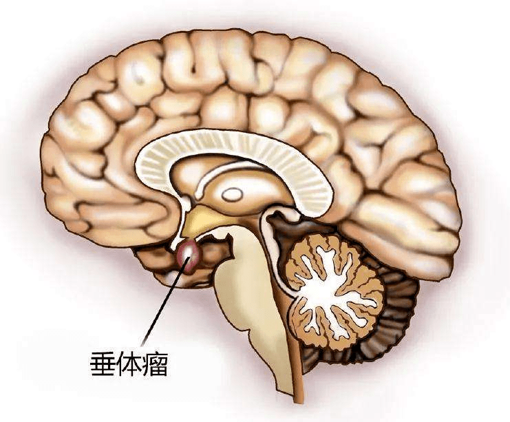 这些症状都和垂体瘤有关快来看看你有吗