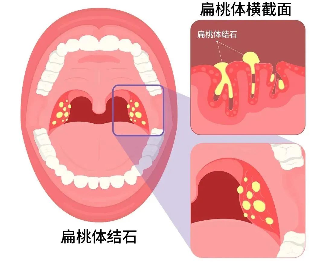 扁桃體結石這顆奇臭無比的