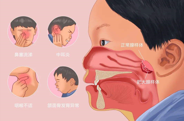 儿童时期因免疫抵抗力差,易患急性鼻炎,鼻咽炎,鼻窦炎,扁桃体炎,反复