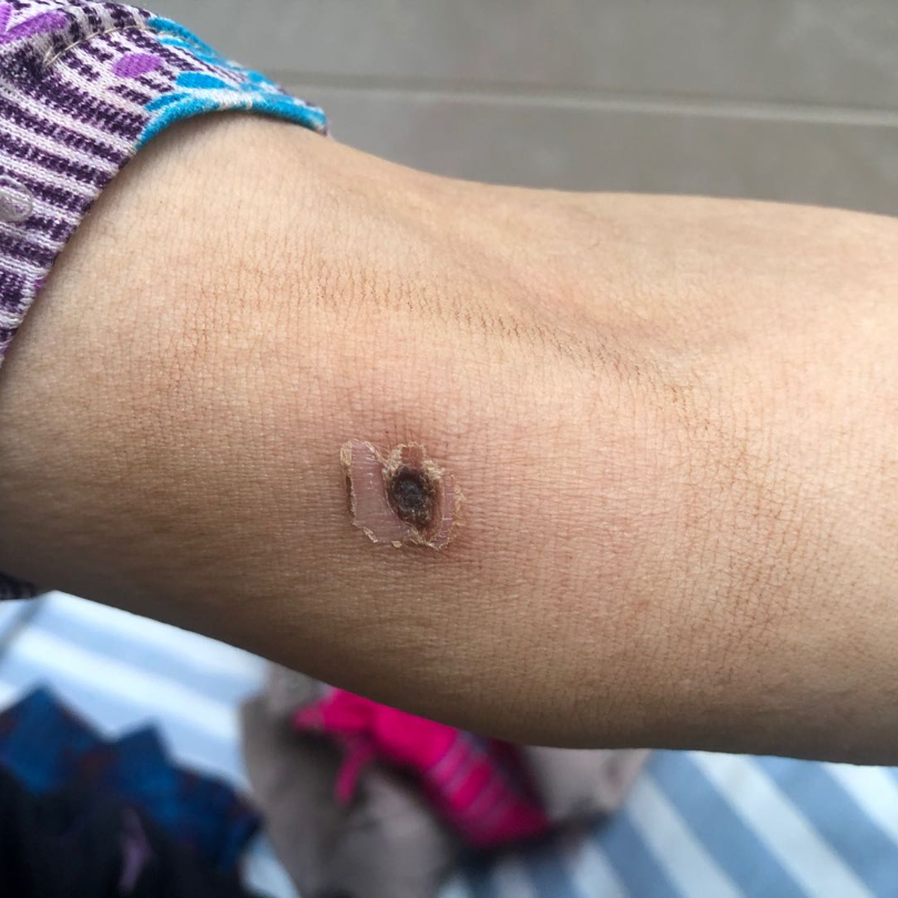 小小恙虫危及生命高发季节莫大意