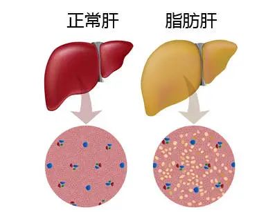 一直吃素很健康错了也会得脂肪肝