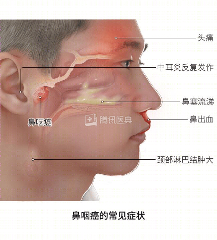 例如中式咸鱼,有充分的证据提示,中式咸鱼会导致鼻咽癌,而且吃得越多