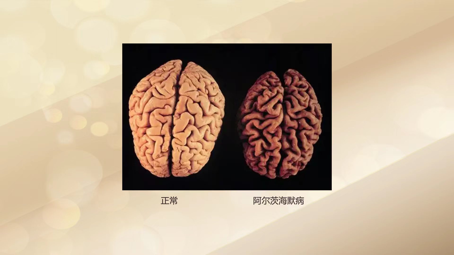 老年健康说06远离记忆的橡皮擦预防阿尔茨海默病