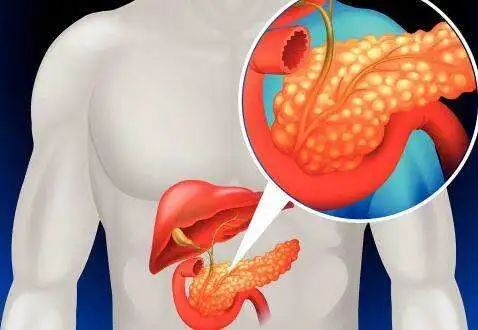 脂源性胰腺炎 湖北网络广播电视台